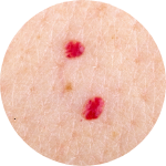 Cherry Angioma removal at La Belle Jolie